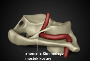 anomalia kimmerlego 300x202 - Arcuate foramen (anomalia Kimmerlego)- co warto wiedzieć?